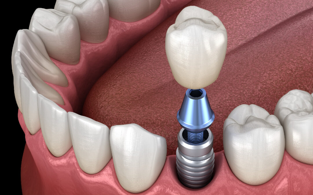 Cirugía Bucal e Implantes