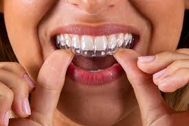 ORTODONCIA INVISIBLE